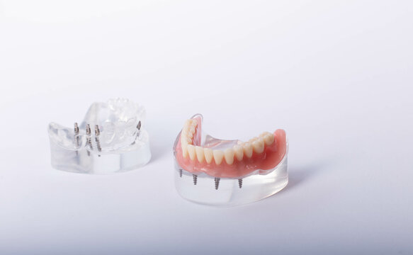 Removable mandibular prosthesis All on 4 system supported by implants.