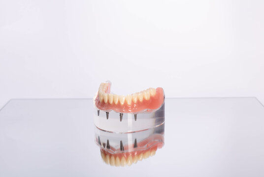 Removable mandibular prosthesis All on 4 system supported by implants.