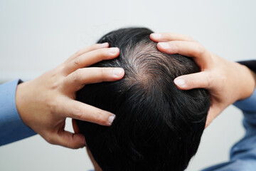Naklejka premium Bald head in man, hair loss treatment health problem.