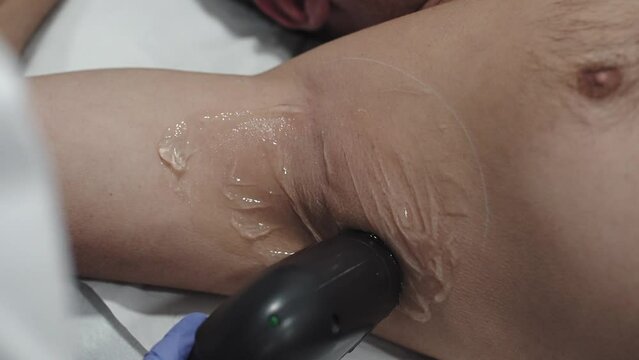 Laser hair removal on man's armpit - close up