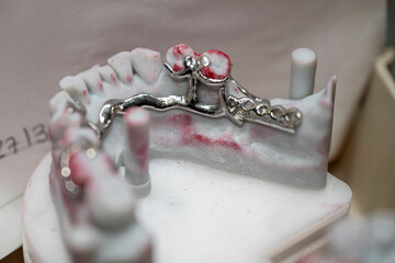 bridge pour ajout de dents en céramique fabriqué en laboratoire © Esta Webster