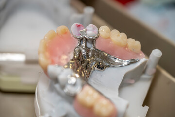 création en laboratoire de bridge avec stellite pour remplacement de dents