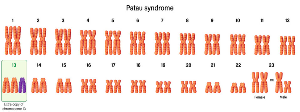 Karyotype of Patau syndrome. Autosomal abnormalities. Trisomy 13. Genetic disorder. 