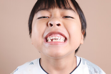 Close up of boy teeth. Kid patient open mouth showing cavities teeth decay.