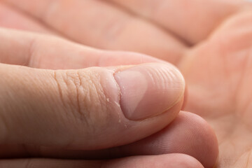 Ridged fingernails with vertical and horizontal ridges. Nails problems.