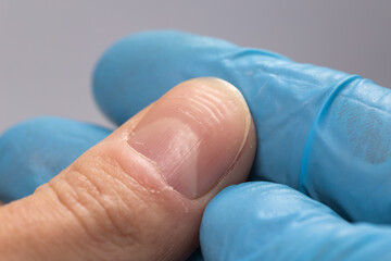Doctor examining a ridged fingernails with vertical and horizontal ridges. Nails problems