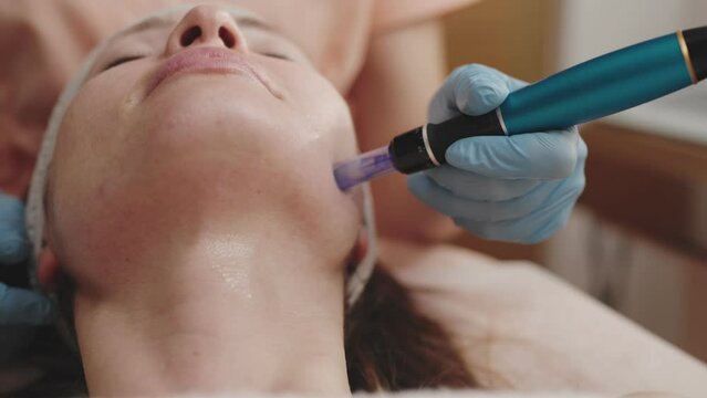 Close-up of a professional dermatologist using a derma pen on a patient's face during a microneedling procedure to rejuvenate the skin.