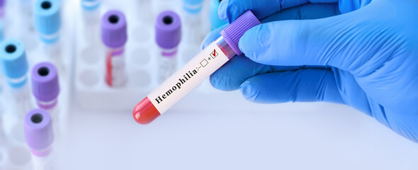 Doctor holding a test blood sample tube with positive Hemophilia test on the background of medical test tubes with analyzes. © syhin_stas
