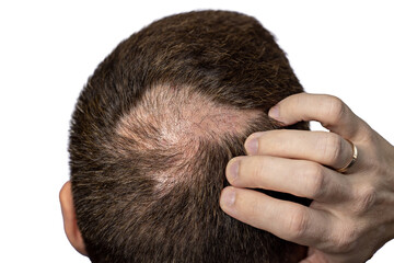 Person with Hair Loss problems closeup. Alopecia Balding Hairs on man Scalp. Human Alopecia or Hair Loss. Scratching his Head. Baldness. Depression, Stress. PNG Design Element. - 773362299