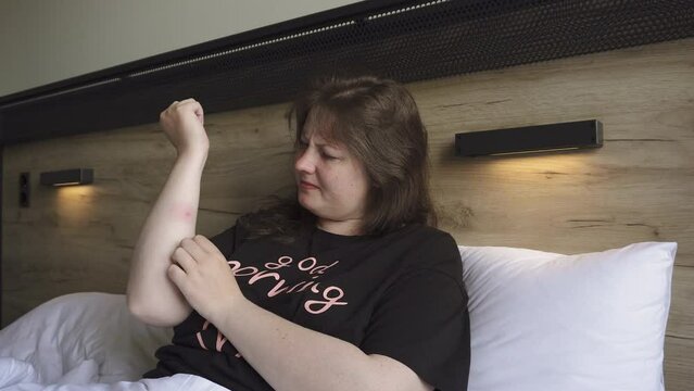 Portrait of white woman in hotel bed feels pain and itching at site of insect bite while traveling. Allergic reaction to bloodsucker bite and tourist feeling of discomfort during vacation.
