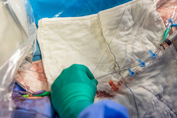 Heart stent placement process in operating room. Heart doctor inserting central venous catheter,...