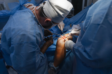 close-up of a severed human knee on an operating table where knee replacement surgery is being performed