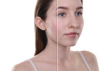 Acne problem, collage. Photo of woman divided into halves before and after treatment on white...