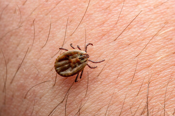 Infectious Encephalitis Tick Insect on Skin. Encephalitis Virus or Lyme Borreliosis Disease...