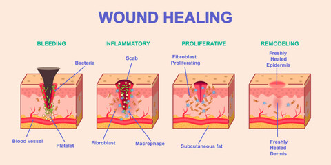 Wound healing process. Medical infographics or diagram with stages or phases of skin regeneration after injury. Bleeding, Inflammation, Proliferation and Remodeling. Cartoon flat vector illustration - obrazy, fototapety, plakaty
