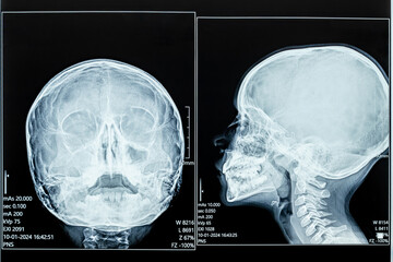 Child's 8 y.o. Skull X-ray: Side and Front Views.