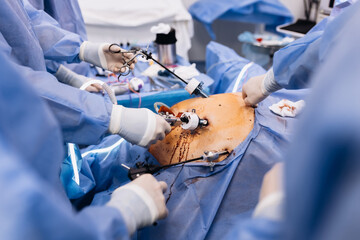 Professional surgeons in the operating room. Instrument for laparoscopic surgery. A surgeon performs laparoscopic gastric surgery in the operating room. - obrazy, fototapety, plakaty