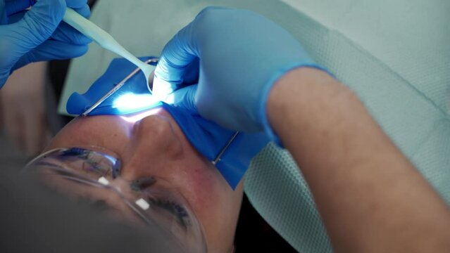 Close-up shot of dentist's hands treating root canals, patient with cofferdam in modern dental clinic. Doctor's hands treat woman's tooth, using mirror. Elimination of caries, installation of filling.