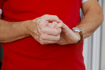 A senior Caucasian man with vitiligo is wearing red polo shirt and holding his hands.