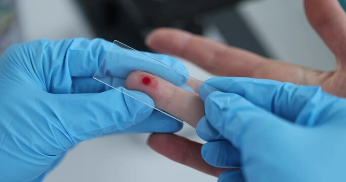Nurse in gloves taking blood from patient finger using glass slide in laboratory closeup 4k movie slow motion. Complete blood count laboratory diagnostics