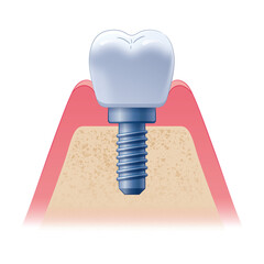 インプラント断面図