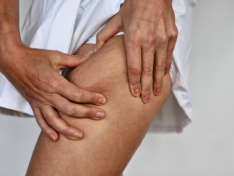 Woman shows and holds and pushes leg skin, cellulite, orange peel. Treatment and elimination of excess weight