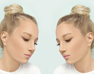 Thinning hair and hair loss,female pattern baldness,Hair transplant