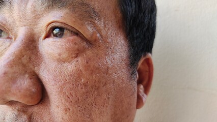portrait the wrinkle and Flabby skin, blackhead and acne, blemish and freckles on the face, ptosis and loose of the male, rash and hives, health care and medical concept. - obrazy, fototapety, plakaty