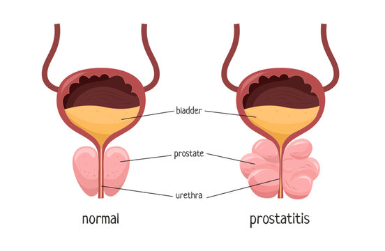 Vector illustration of a healthy prostate and prostatitis. Medical poster.
