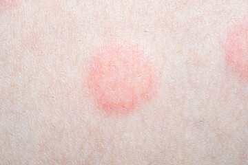 Skin allergy rash dermatitis texture close up - obrazy, fototapety, plakaty