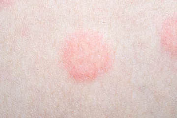 Foto op Canvas Skin allergy rash dermatitis texture close up © Piman Khrutmuang