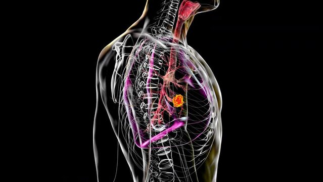 Animation showing a lung tumour