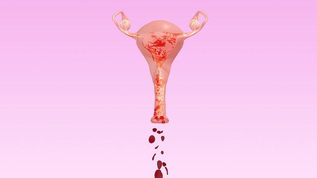 Menorrhagia also known as heavy menstrual bleeding or hematomunia