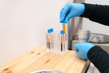Gloved nurse placing blood sample into rack for PRP therapy.