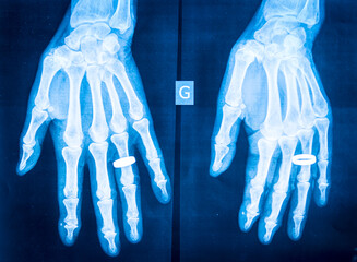 X-ray of rheumatism in the hands. - 775060006