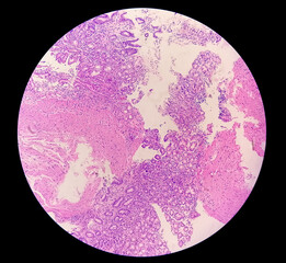 Photomicrographic view of histological stained slide showing carcinoma. Adenocarcinoma