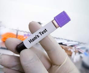 Blood sample for HAM'S Test to diagnose paroxysmal nocturnal hemoglobinuria (PNH).