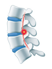 腰椎椎間板ヘルニア