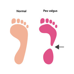 Normal and pes valgus foot 