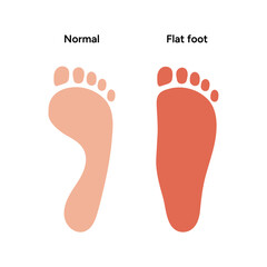 Normal and flat foot