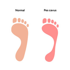 Normal and pes cavus foot