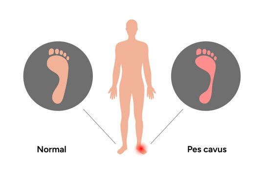 Normal and pes cavus foot