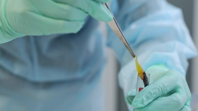 PRF platelet rich fibrin in dental surgery. Dentist's hands working with fibrin clot in tube. Doctor holding platelet rich fibrin clot in the modern dental clinic. PRF membrane preparation. Close-up.