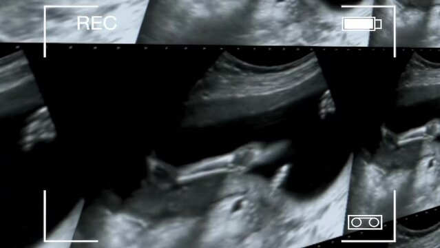 Ultrasound of the baby in the womb. Medical images collage of ultrasound during pregnancy woman showing fetus in third month