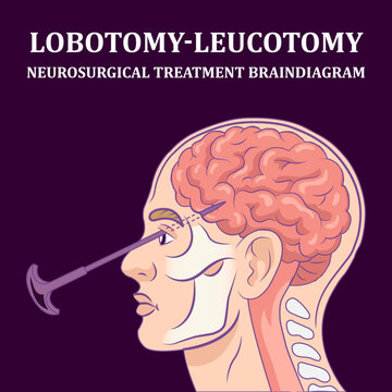 Brain Diagram: Lobotomy leucotomy neurosurgical treatment in brain diagram schematic raster illustration. Medical science educational illustration
