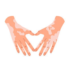 Light-skinned human hands depigmented from vitiligo, forming a heart-shaped symbol