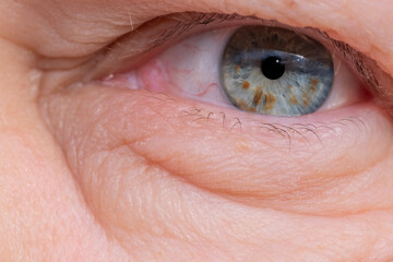 female eye mature woman, close-up wrinkles, under eye bags, swelling on lower eyelid, allergies,...