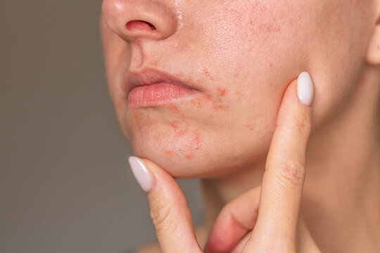 Close-up photo of the face of a young Caucasian woman suffering from perioral dermatitis near the mouth. Skin problems. Dermatology. Skin diseases.