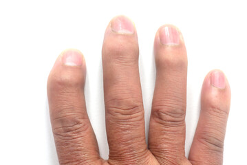 老人の手指の病気のクローズアップ