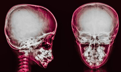 normal skull x ray anterior and lateral view	